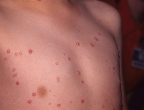 Chicken pox